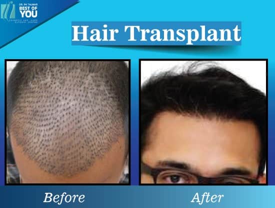  Before After Results of hair transplant